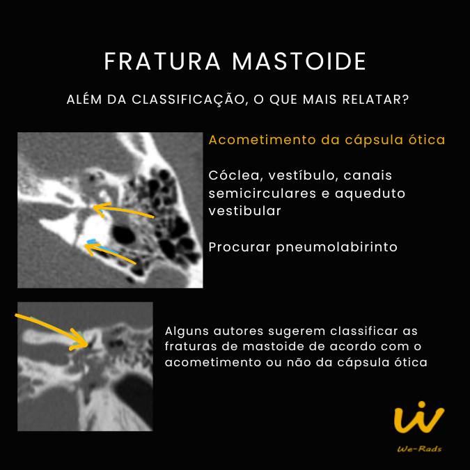 FRATURA MASTOIDE (6)