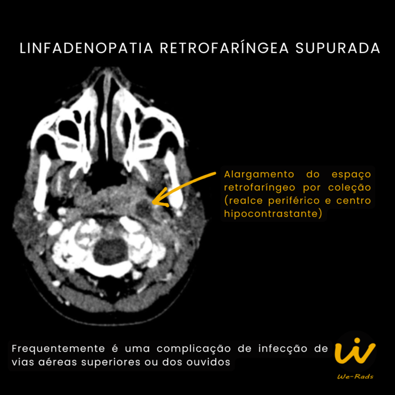 LINFADENOPATIA RETROFARÍNGEA (2)