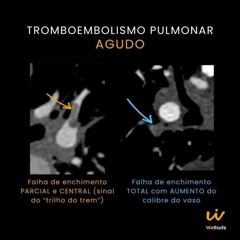 BLOG TEP agudo vs cronico (2)