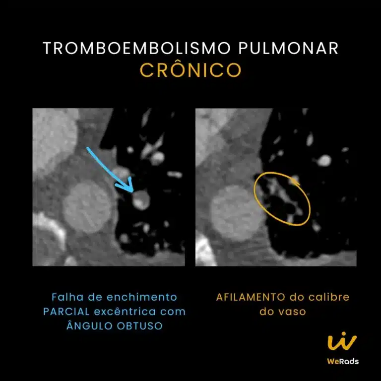 BLOG TEP agudo vs cronico (3)