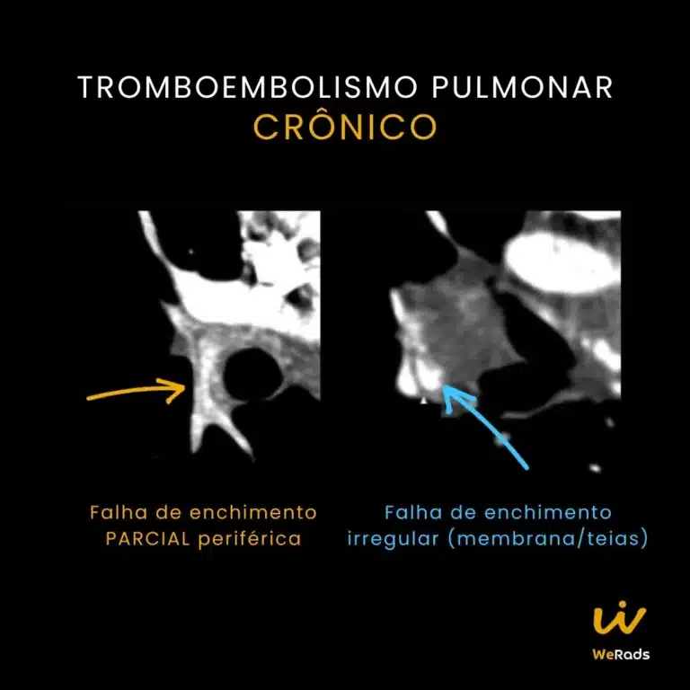 BLOG TEP agudo vs cronico (4)