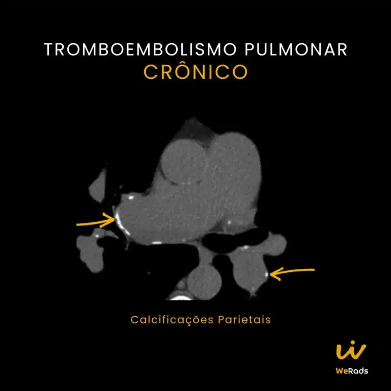 BLOG TEP agudo vs cronico (5)