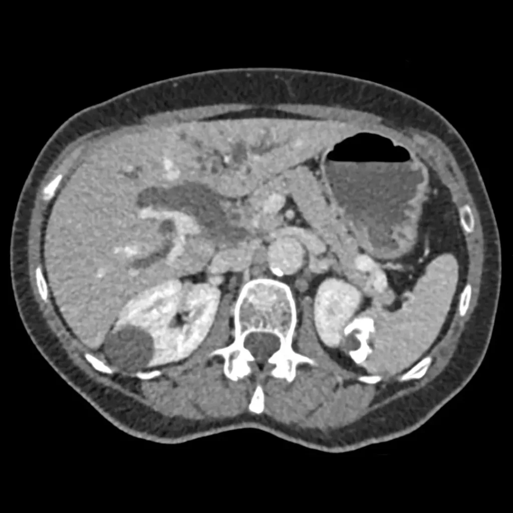 neoplasia pancreática primária - tomografia