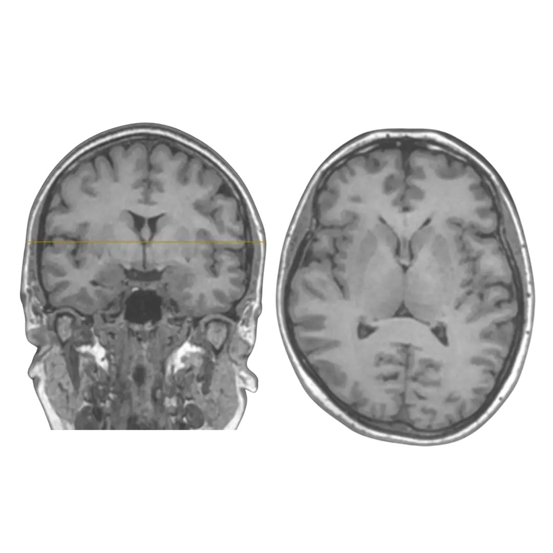 Núcleos da base em ressonância magnética nos planos coronal e axial