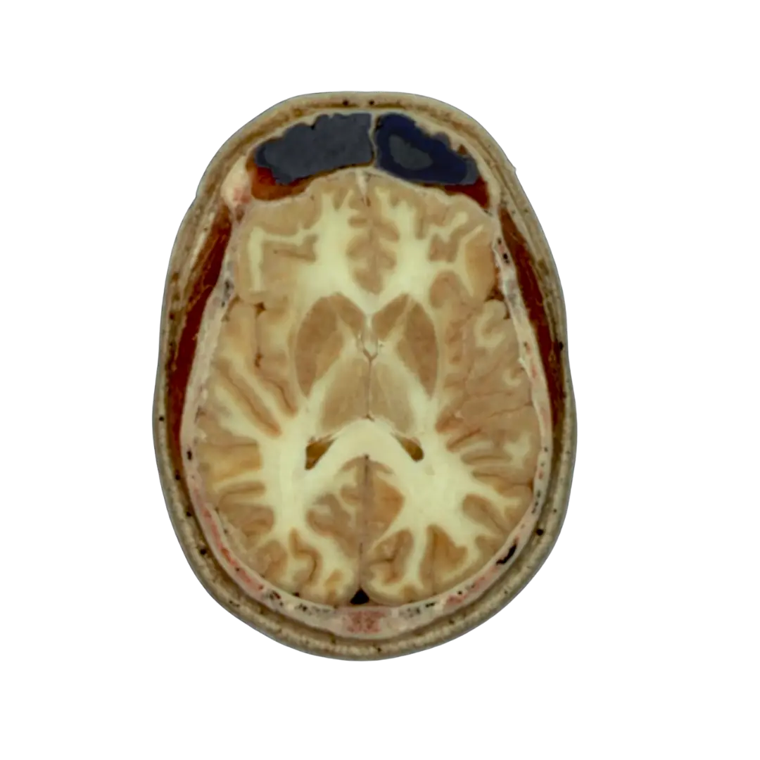Núcleos da base em corte axial de cérebro humano real