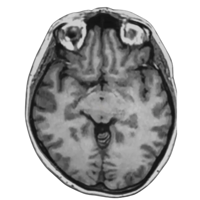 Ressonância magnética do encéfalo em plano axial